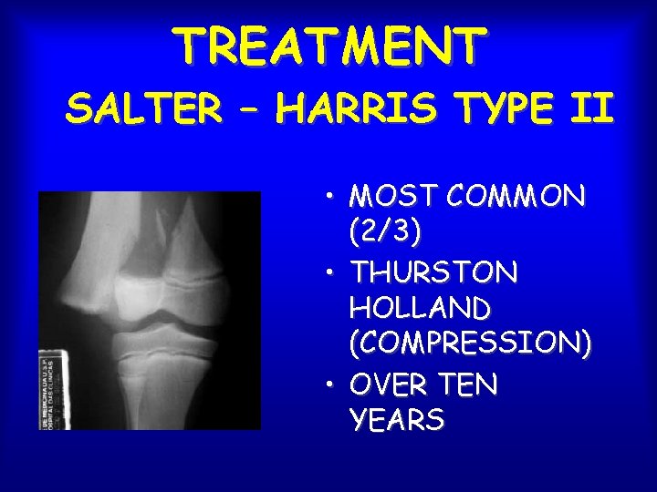 TREATMENT SALTER – HARRIS TYPE II • MOST COMMON (2/3) • THURSTON HOLLAND (COMPRESSION)