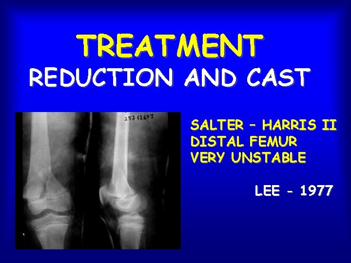 TREATMENT REDUCTION AND CAST SALTER – HARRIS II DISTAL FEMUR VERY UNSTABLE LEE -