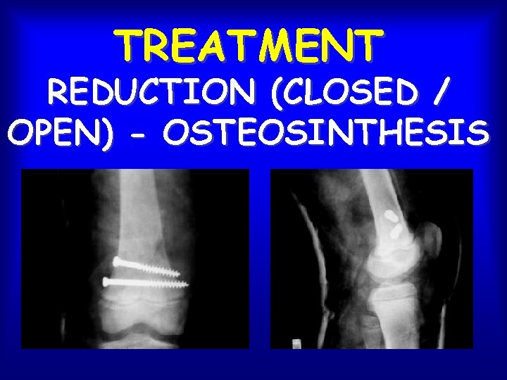 TREATMENT REDUCTION (CLOSED / OPEN) - OSTEOSINTHESIS 