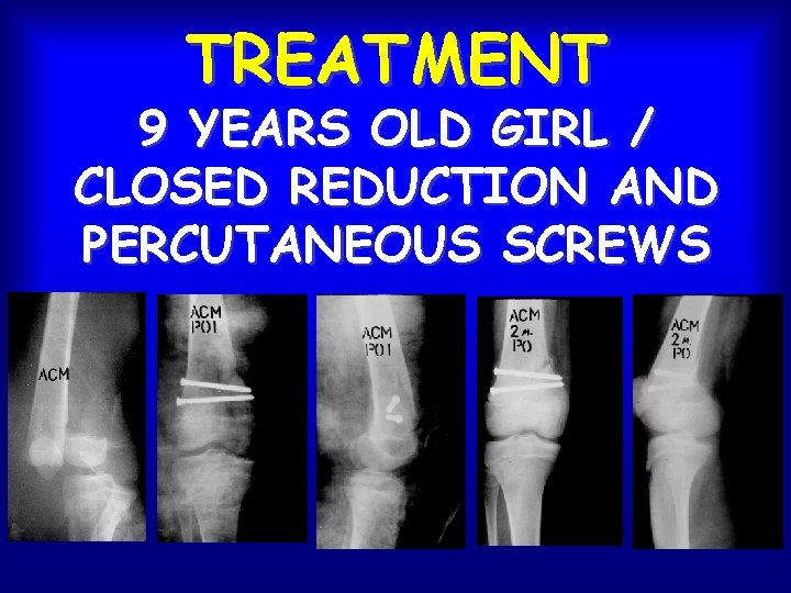TREATMENT 9 YEARS OLD GIRL / CLOSED REDUCTION AND PERCUTANEOUS SCREWS 