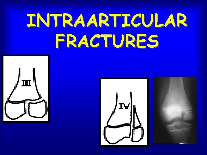INTRAARTICULAR FRACTURES 