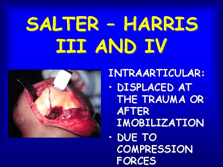 SALTER – HARRIS III AND IV INTRAARTICULAR: • DISPLACED AT THE TRAUMA OR AFTER