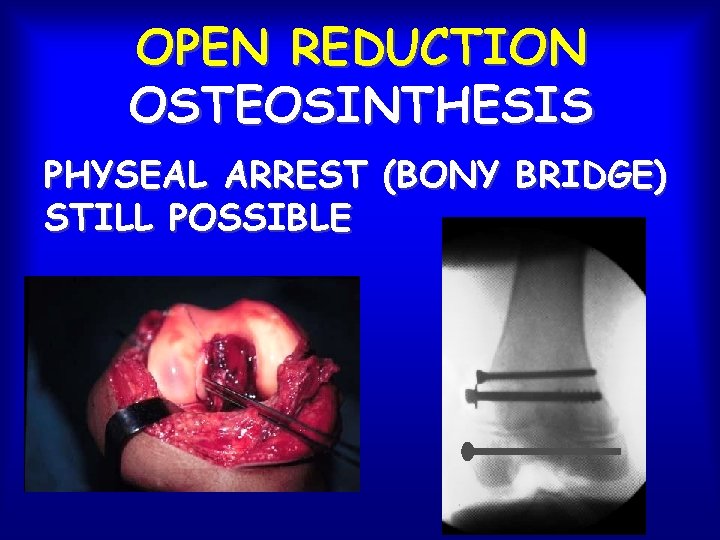 OPEN REDUCTION OSTEOSINTHESIS PHYSEAL ARREST (BONY BRIDGE) STILL POSSIBLE 