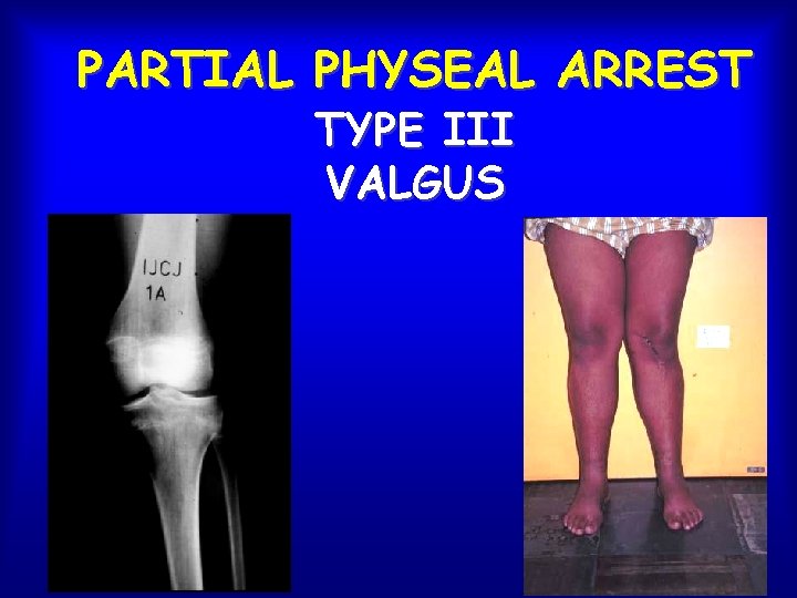 PARTIAL PHYSEAL ARREST TYPE III VALGUS 