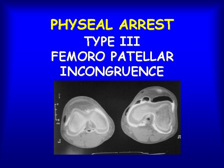 PHYSEAL ARREST TYPE III FEMORO PATELLAR INCONGRUENCE 