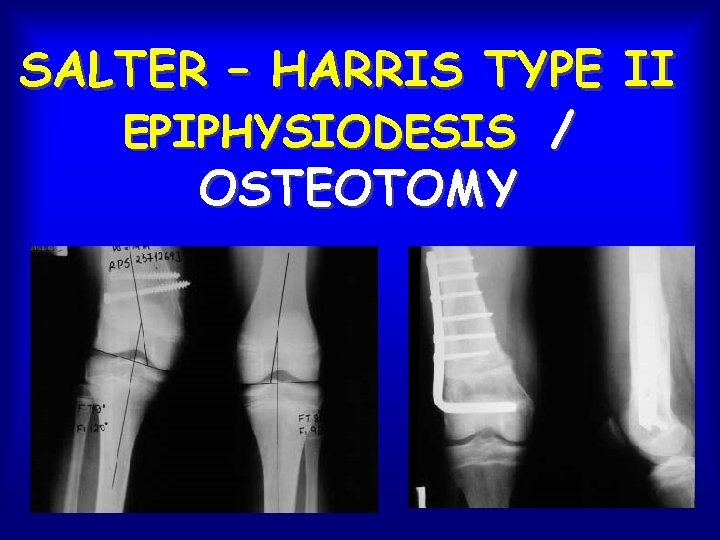 SALTER – HARRIS TYPE II EPIPHYSIODESIS / OSTEOTOMY 