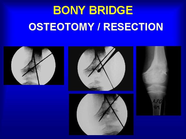 BONY BRIDGE OSTEOTOMY / RESECTION 