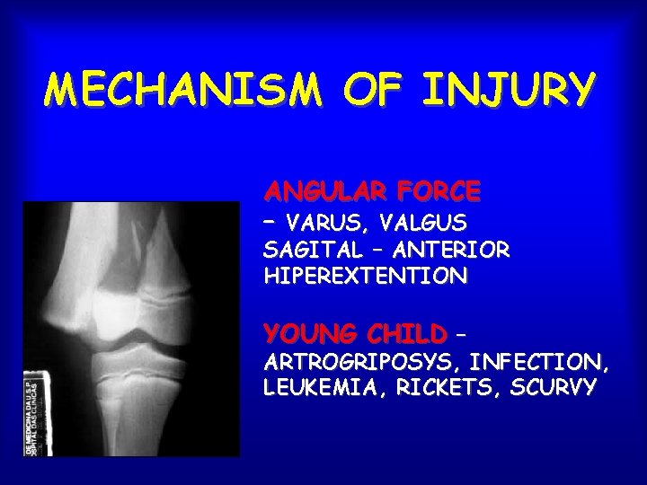 MECHANISM OF INJURY ANGULAR FORCE – VARUS, VALGUS SAGITAL – ANTERIOR HIPEREXTENTION YOUNG CHILD