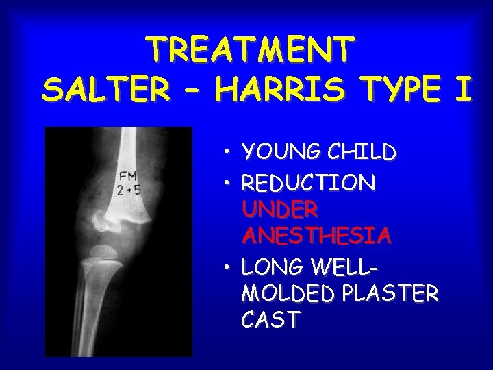 TREATMENT SALTER – HARRIS TYPE I • YOUNG CHILD • REDUCTION UNDER ANESTHESIA •