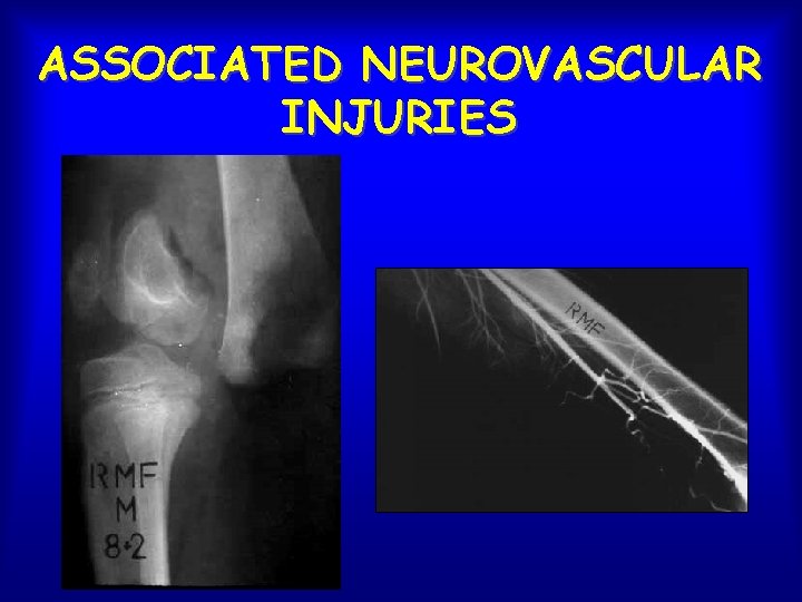 ASSOCIATED NEUROVASCULAR INJURIES 
