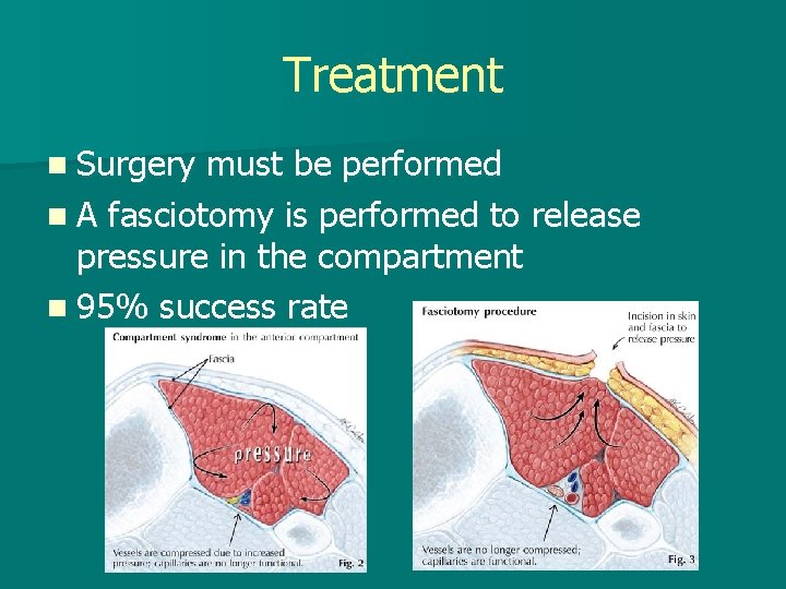 Treatment n Surgery must be performed n A fasciotomy is performed to release pressure