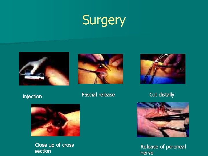 Surgery injection Close up of cross section Fascial release Cut distally Release of peroneal