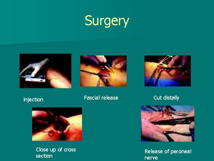 Surgery injection Close up of cross section Fascial release Cut distally Release of peroneal