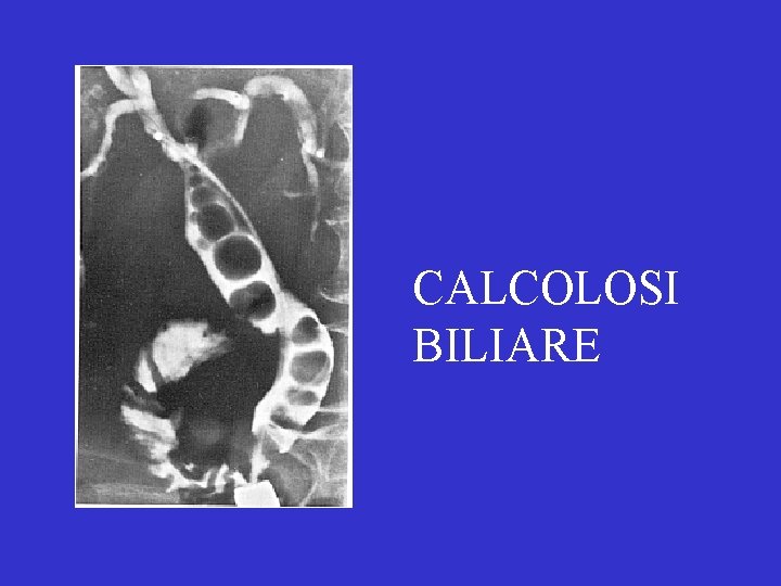 CALCOLOSI BILIARE 