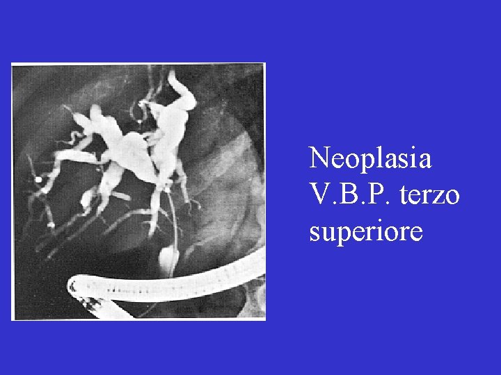 Neoplasia V. B. P. terzo superiore 