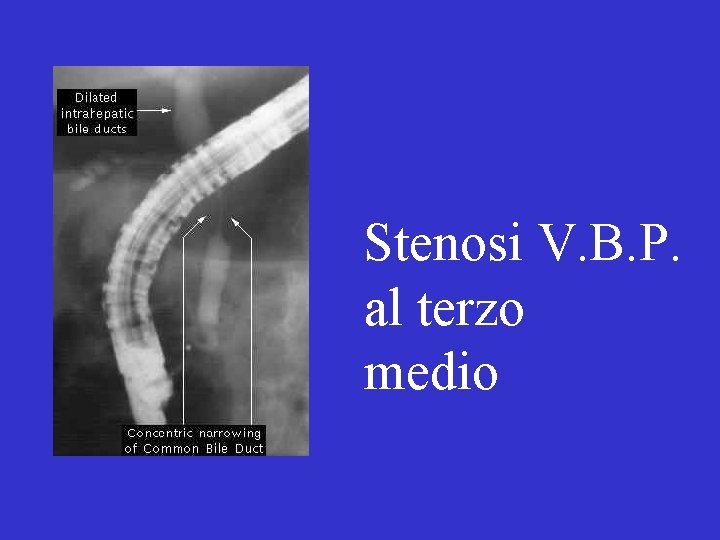 Stenosi V. B. P. al terzo medio 