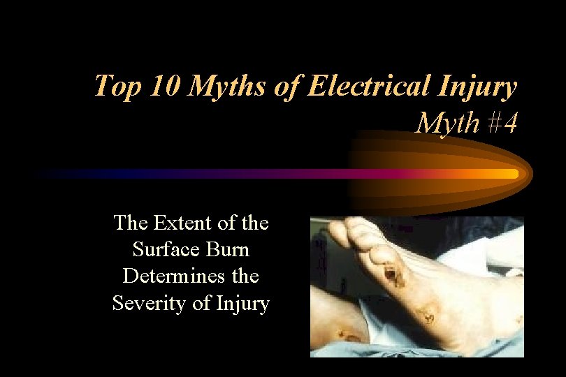 Top 10 Myths of Electrical Injury Myth #4 The Extent of the Surface Burn