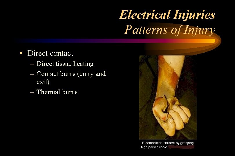 Electrical Injuries Patterns of Injury • Direct contact – Direct tissue heating – Contact