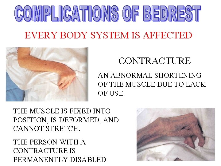 EVERY BODY SYSTEM IS AFFECTED CONTRACTURE AN ABNORMAL SHORTENING OF THE MUSCLE DUE TO