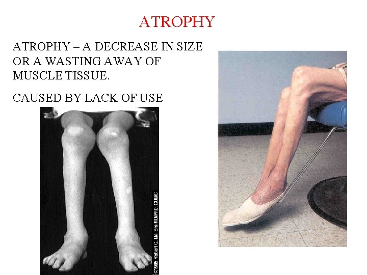 ATROPHY – A DECREASE IN SIZE OR A WASTING AWAY OF MUSCLE TISSUE. CAUSED