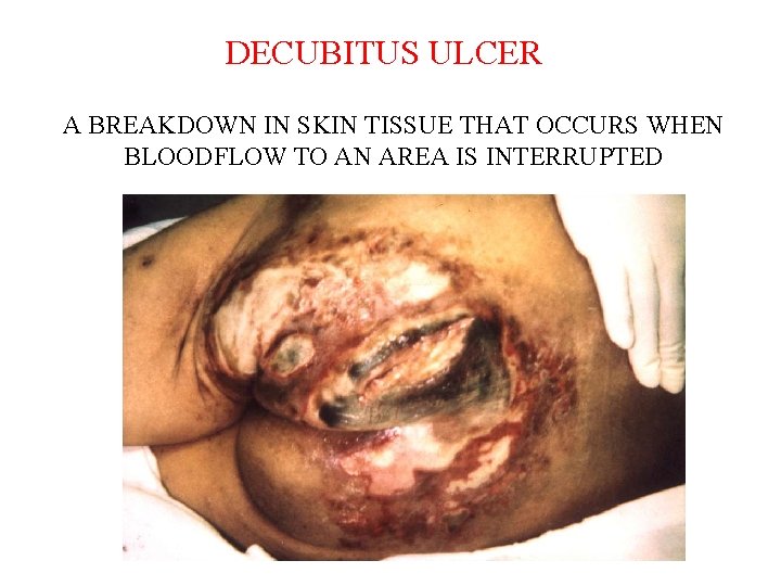 DECUBITUS ULCER A BREAKDOWN IN SKIN TISSUE THAT OCCURS WHEN BLOODFLOW TO AN AREA