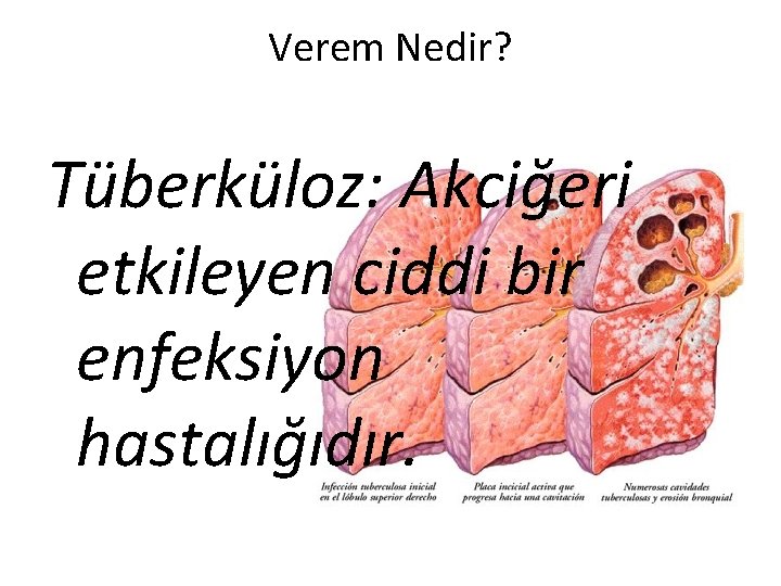 Verem Nedir? Tüberküloz: Akciğeri etkileyen ciddi bir enfeksiyon hastalığıdır. 