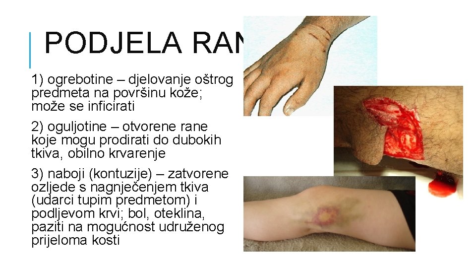 PODJELA RANA 1) ogrebotine – djelovanje oštrog predmeta na površinu kože; može se inficirati