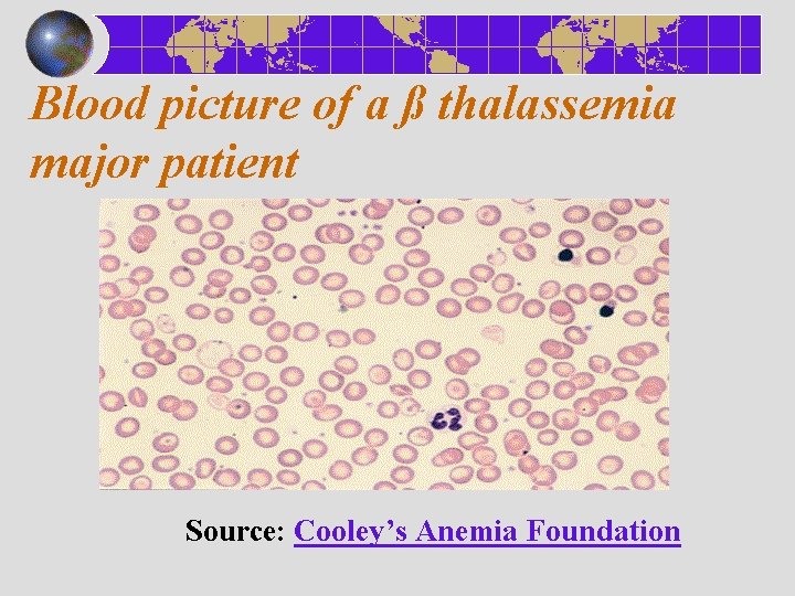 Blood picture of a ß thalassemia major patient Source: Cooley’s Anemia Foundation 