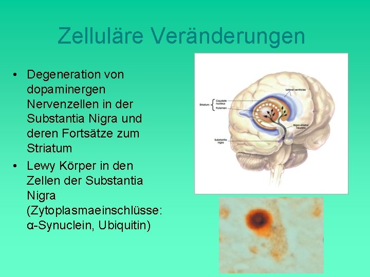 Zelluläre Veränderungen • Degeneration von dopaminergen Nervenzellen in der Substantia Nigra und deren Fortsätze