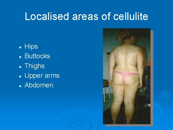 Localised areas of cellulite l l l Hips Buttocks Thighs Upper arms Abdomen 