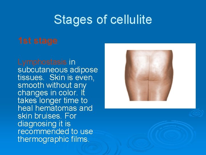 Stages of cellulite 1 st stage Lymphostasis in subcutaneous adipose tissues. Skin is even,