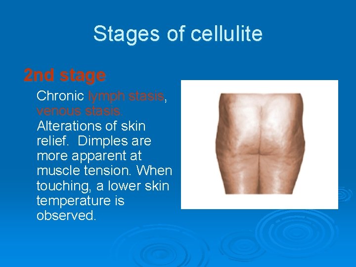 Stages of cellulite 2 nd stage Chronic lymph stasis, venous stasis. Alterations of skin
