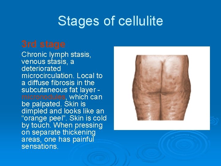 Stages of cellulite 3 rd stage Chronic lymph stasis, venous stasis, a deteriorated microcirculation.