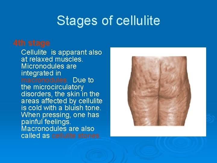 Stages of cellulite 4 th stage Cellulite is apparant also at relaxed muscles. Micronodules