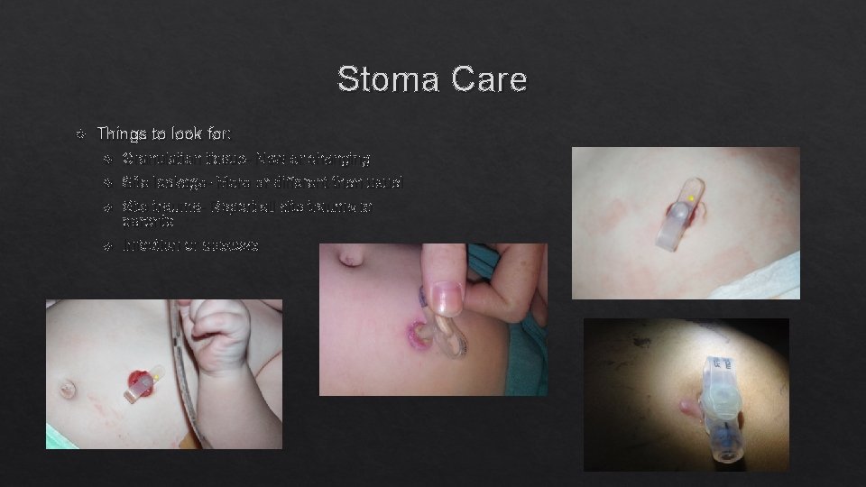 Stoma Care Things to look for: Granulation tissue- New or changing Site leakage- More