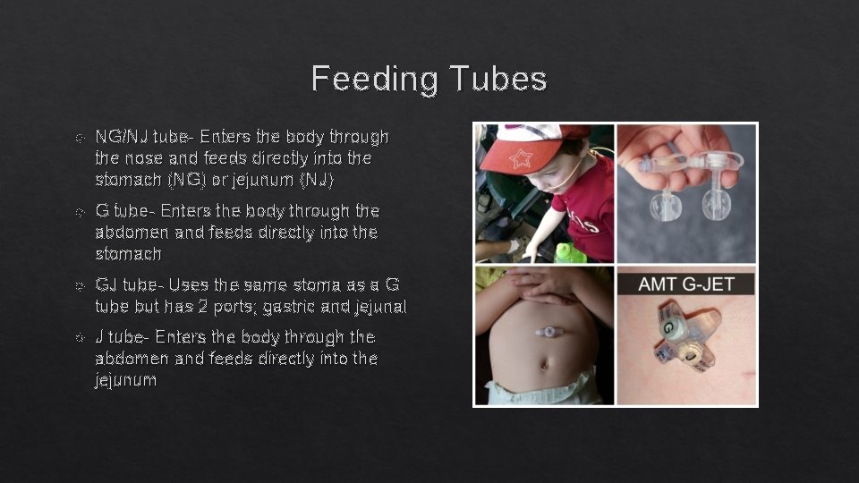 Feeding Tubes NG/NJ tube- Enters the body through the nose and feeds directly into