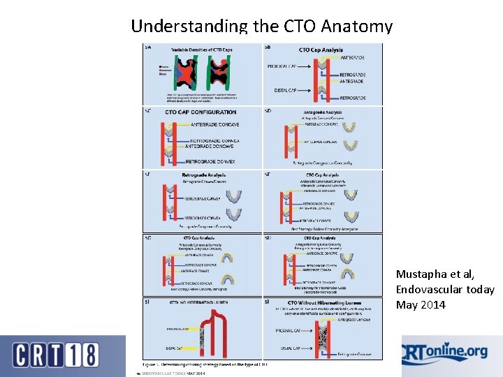 Understanding the CTO Anatomy Mustapha et al, Endovascular today May 2014 