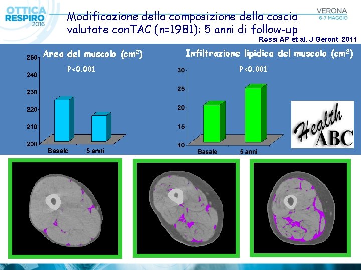 Modificazione della composizione della coscia valutate con. TAC (n=1981): 5 anni di follow-up Rossi