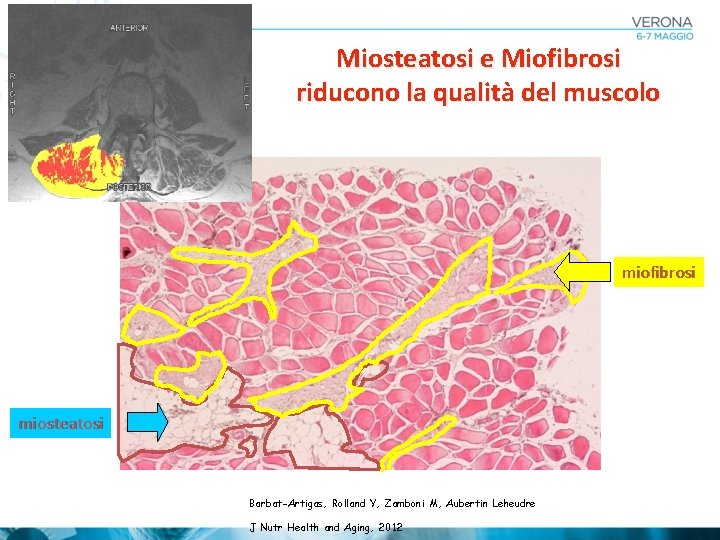 Miosteatosi e Miofibrosi riducono la qualità del muscolo miofibrosi miosteatosi Barbat-Artigas, Rolland Y, Zamboni