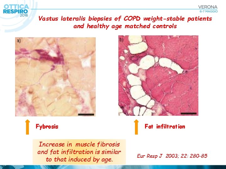 Vastus lateralis biopsies of COPD weight-stable patients and healthy age matched controls * Fybrosis