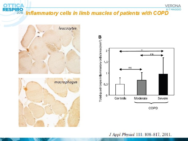 Inflammatory cells in limb muscles of patients with COPD leucocytes macrophages 
