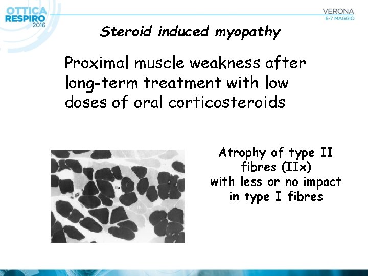 Steroid induced myopathy Proximal muscle weakness after long-term treatment with low doses of oral