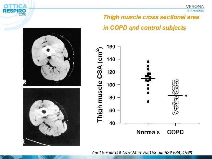 Thigh muscle cross sectional area in COPD and control subjects Am J Respir Crit