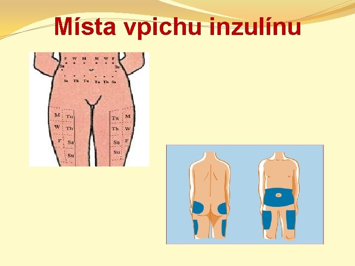 Místa vpichu inzulínu 