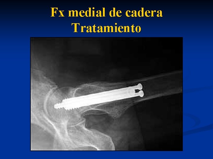 Fx medial de cadera Tratamiento 