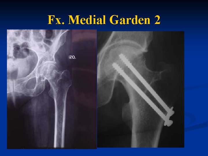  Fx. Medial Garden 2 