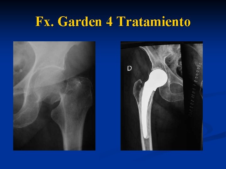  Fx. Garden 4 Tratamiento 