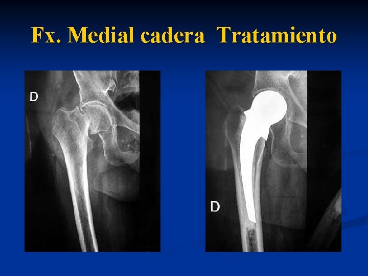 Fx. Medial cadera Tratamiento 