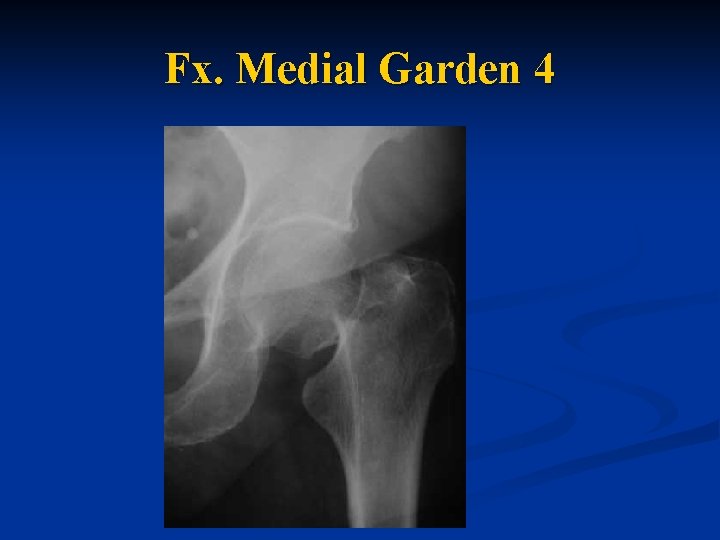  Fx. Medial Garden 4 