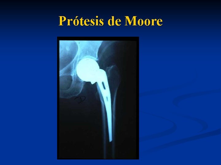 Prótesis de Moore 